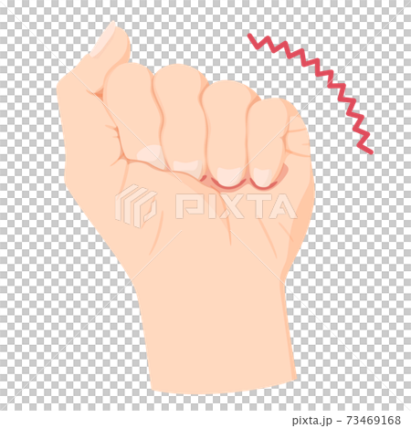 手の拘縮のイラスト 73469168