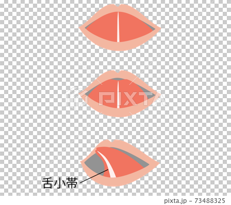 Illustration that becomes a heart shape when the tongue is stretched due to ankyloglossia 73488325