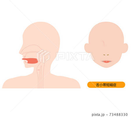 舌小帯短縮症で伸ばせない舌のイラスト 73488330