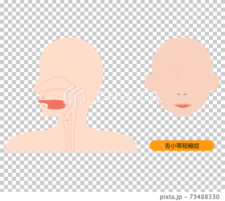 舌小帯短縮症で伸ばせない舌のイラスト 73488330