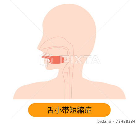 舌小帯短縮症で伸ばせない舌のイラスト　 73488334
