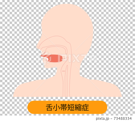 舌小帯短縮症で伸ばせない舌のイラスト　 73488334