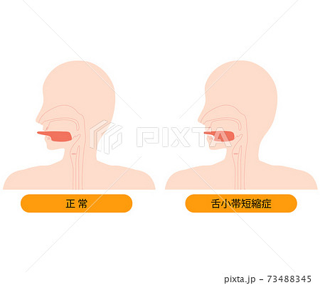 正常な舌と、舌小帯短縮症で伸ばせない舌のイラスト　 73488345