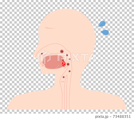 Tonsillitis inflammation illustration Tonsillitis inflammation illustration 73488351