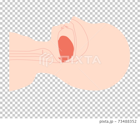 Sleep apnea syndrome illustration with the tongue down 73488352