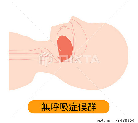 睡眠時無呼吸症候群 舌が下がっているイラスト 睡眠時無呼吸症候群 舌が下がっているイラスト 73488354