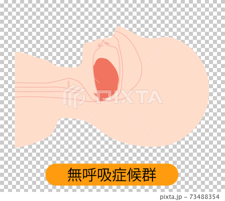 睡眠時無呼吸症候群 舌が下がっているイラスト 睡眠時無呼吸症候群 舌が下がっているイラスト 73488354