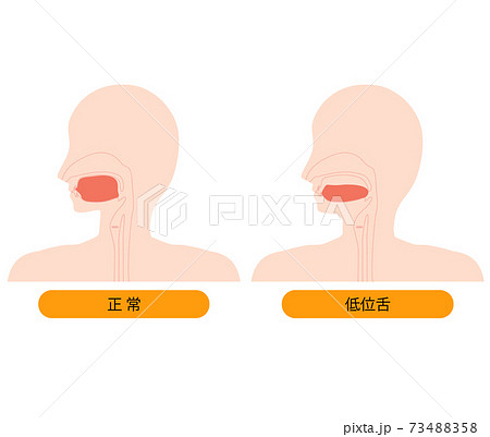 正しい舌の位置と低位舌のイラスト 正しい舌の位置と低位舌のイラスト 73488358