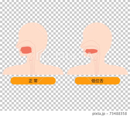正しい舌の位置と低位舌のイラスト 正しい舌の位置と低位舌のイラスト 73488358