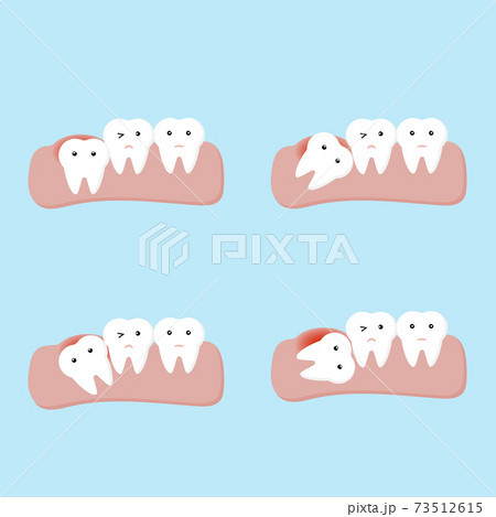 impacted tooth or wisdom teeth dental and oral diseases 73512615