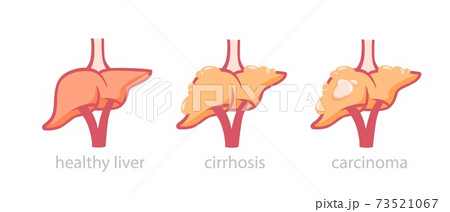 Healthy liver and tumor damaged illustration. Process transformation normal organ into fatty hepatosis and cirrhosis. Healthy liver and tumor damaged illustration. Process transformation normal organ into fatty hepatosis and cirrhosis. 73521067