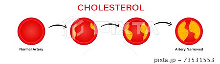 Stages cholesterol formation in erythrocytes clipart. Filling red blood cells with yellow thrombus. Stages cholesterol formation in erythrocytes clipart. Filling red blood cells with yellow thrombus. 73531553