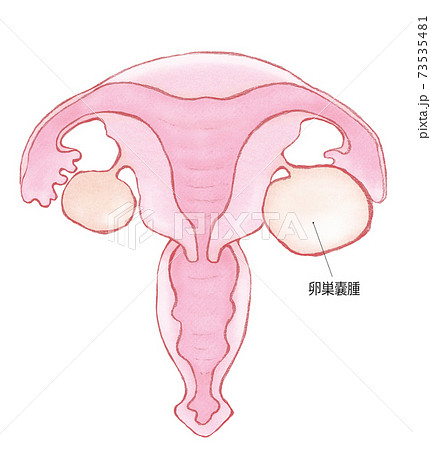 卵巣嚢腫と子宮 名称ありのイラスト素材
