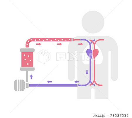 Ecmo エクモ 体外式膜型人工肺 の構造と仕組み 新型コロナウイルス 文字なし のイラスト素材 73587552 Pixta