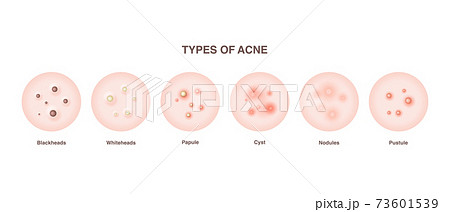 Acne types set 73601539