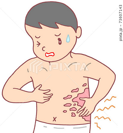 皮膚疾患・帯状疱疹 73607143