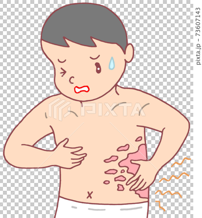 皮膚疾患・帯状疱疹 73607143