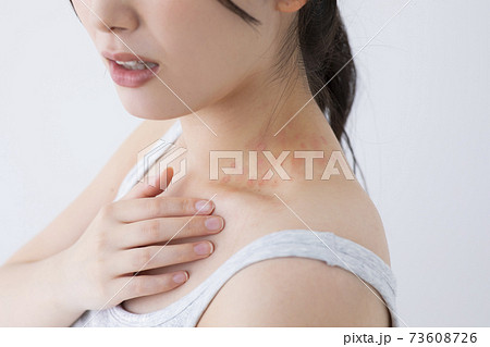 じんましんイメージ　(特殊メイク)  73608726