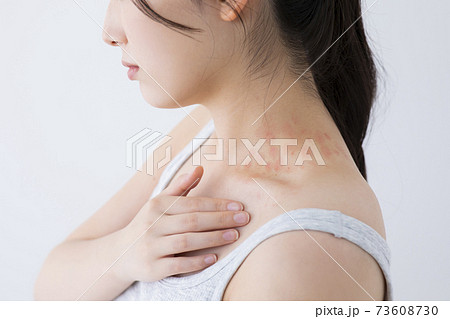 じんましんイメージ　(特殊メイク)  73608730