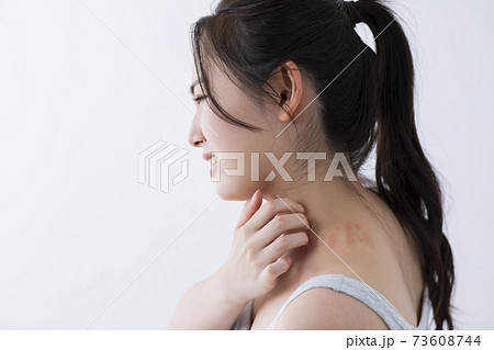 じんましんイメージ (特殊メイク) じんましんイメージ (特殊メイク) 73608744