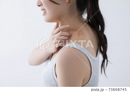 じんましんイメージ　(特殊メイク)  73608745