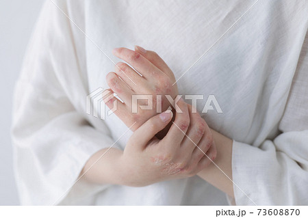 手荒れイメージ (特殊メイク) 手荒れイメージ (特殊メイク) 73608870