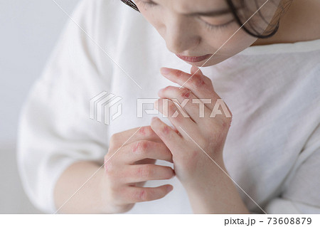 手荒れイメージ　(特殊メイク)  73608879
