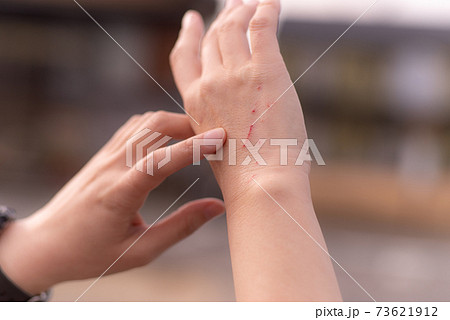 猫にやられたひっかき傷 73621912