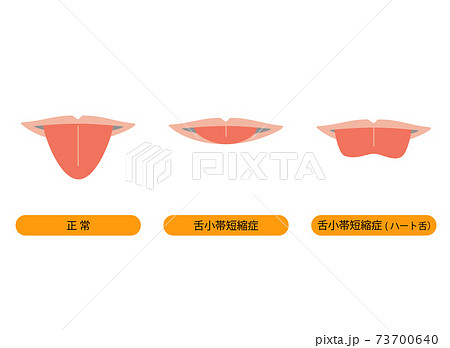 舌小帯短縮症で舌を伸ばすとハート型になるイラスト 73700640