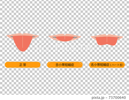舌小帯短縮症で舌を伸ばすとハート型になるイラスト 73700640