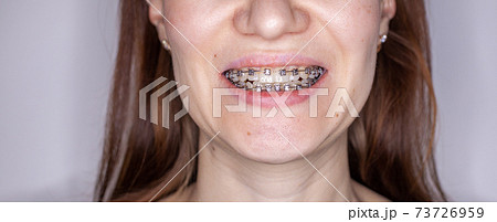 Braces in the smiling mouth of a girl. Smooth teeth from braces. 73726959