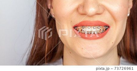 Braces in the smiling mouth of a girl. Smooth teeth from braces. Braces in the smiling mouth of a girl. Smooth teeth from braces. 73726961