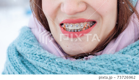 Girl on the street smiles and braces are visible on her teeth 73726962