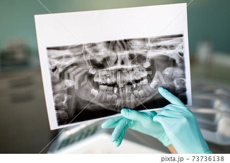 Close up woman dentist holding patient mouth digital film.The dentist explained about the oral cavity to the patient at the dental office 73736138