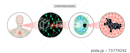 Lymphoma cancer concept 73779292