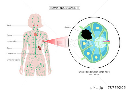 Lymphoma cancer concept 73779296