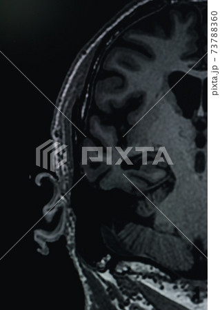 MRI of brain Dementia protocol with Alzheimer's disease  Take a picture from the computer  73788360