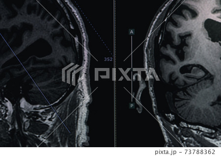 MRI of brain Dementia protocol with Alzheimer's disease  Take a picture from the computer  73788362