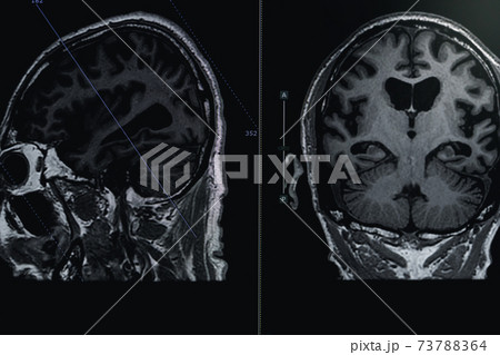 MRI of brain Dementia protocol with Alzheimer's disease Take a picture from the computer MRI of brain Dementia protocol with Alzheimer's disease Take a picture from the computer 73788364