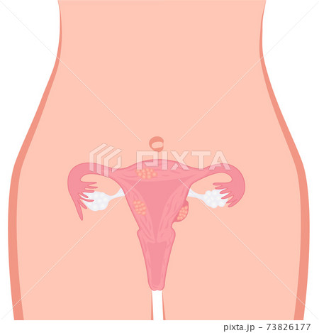 Uterine Fibroid vector illustration. Gynecology problem. Tumor in female reproductive organ 73826177