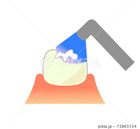 コンポジットレジンCR接着修復法のイラスト コンポジットレジンCR接着修復法のイラスト 73865534