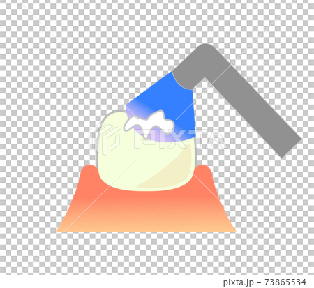 Illustration of composite resin CR adhesive restoration method 73865534