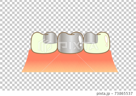 Bridge Caries and Progression and Treatment: Dental Illustration 73865537