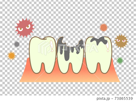 Caries and Periodontal Disease: Dental Illustration 73865539