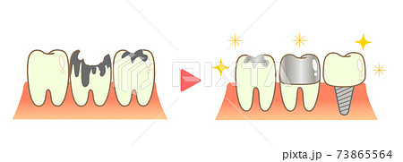 クラウンとインプラント 歯科のイラストのイラスト素材
