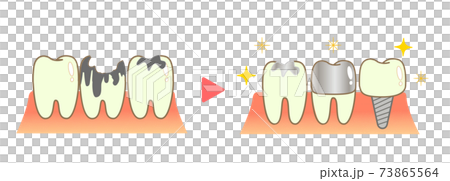 クラウンとインプラント:歯科のイラスト クラウンとインプラント:歯科のイラスト 73865564