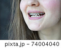 The girl is smiling, braces are installed 74004040