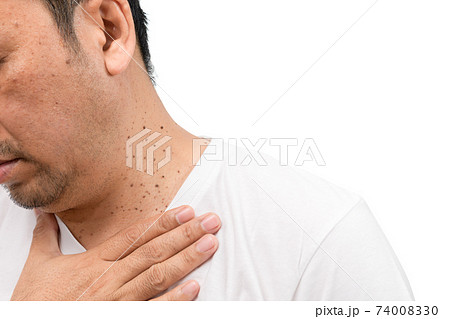 Closed up the Skin Tags or Acrochordon on neck man isolated on white 74008330