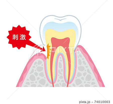 知覚過敏の説明　イラスト 74010003
