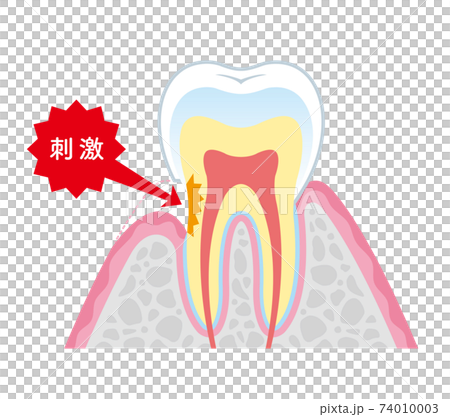 知覚過敏の説明　イラスト 74010003